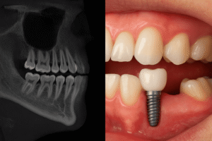 Radiografía TAC de mandíbula con implante dental en clínica de Lanzarote