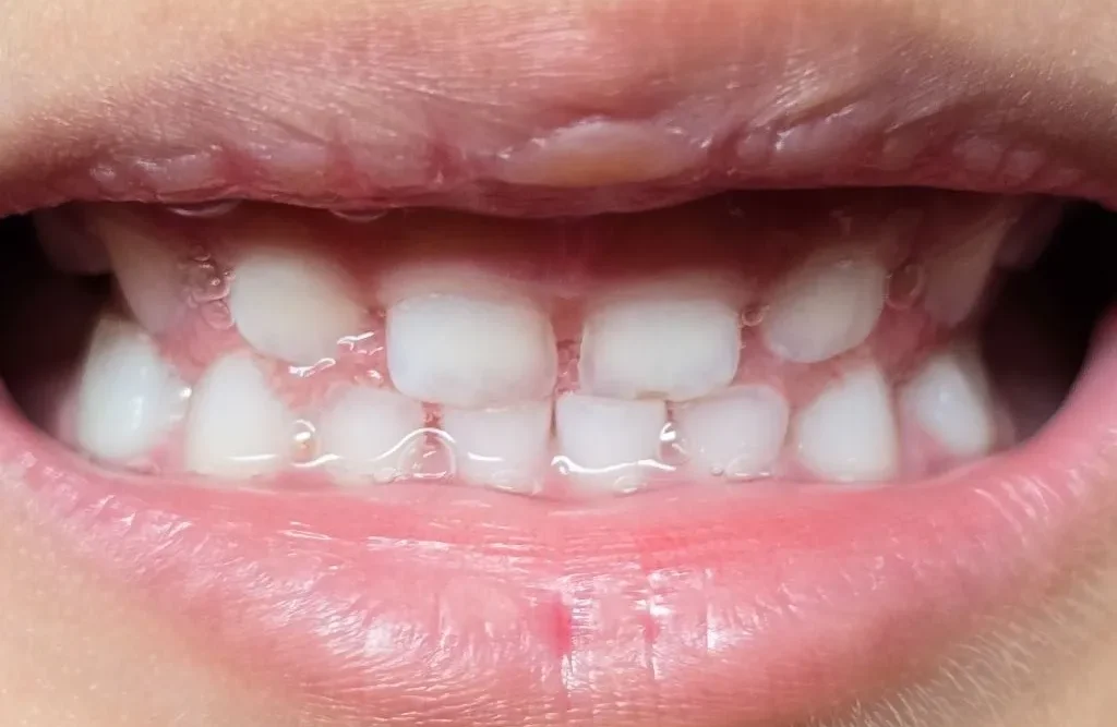 mordida abierta en niños y adultos